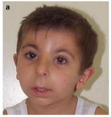 Rubinstein-Taybi syndrome (RTS)