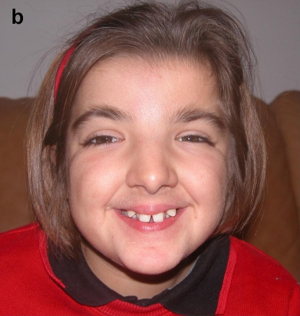 Rubinstein-Taybi syndrome-showing distinctive clinical features